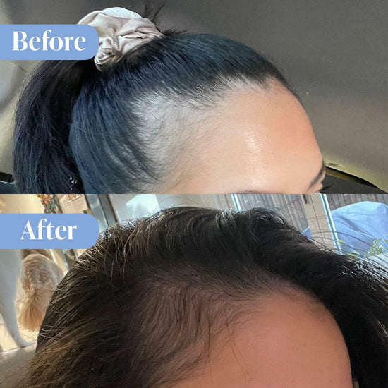 Natural Look Anti-Hair Loss Treatment Bundle